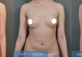 療程效果因人而異，上圖為B罩杯女性在做完自體脂肪隆乳之後​手術後十一個月、手術後一年七個月成效